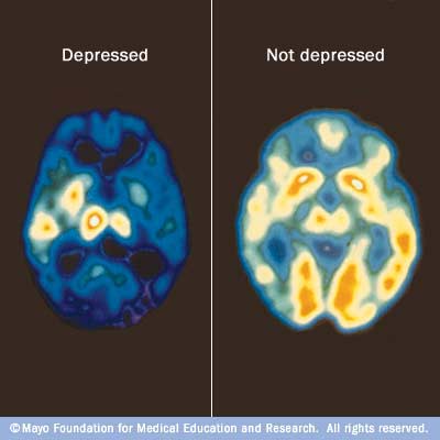 In clinical depression, significant changes occur in the brain's chemistry that are more than feeling sad. In this type of depression, all body systems are involved and create multiple symptoms. (Credit: Mayo Clinic)